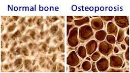normalosteobone