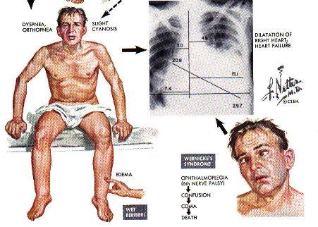 beriberi-alcoholism-thiamine1-deficiency