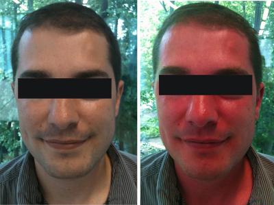 Niacin-Flush-Pi-before-After