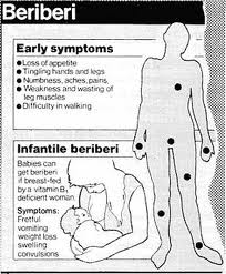 symptoms-of-beriberi-thiamine-deficiency