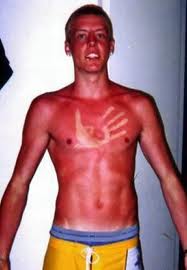 ouch-sunburn-oh-boy