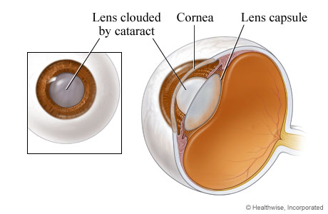 Renovating-Your-Mind-cataract-display