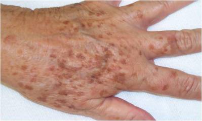 age-spots-lipofuscion-pigment-back-of-hand