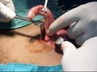 appendix-infected-inflammed-removed-by-physicians